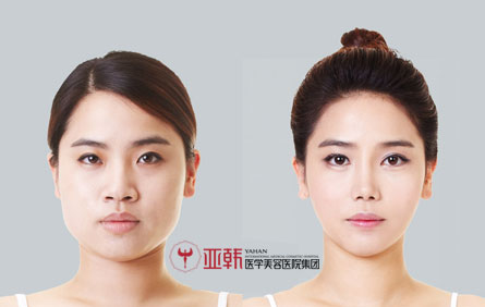面部吸脂对比图