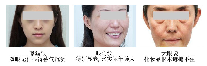 激光祛黑眼圈对比图