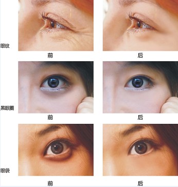 去黑眼圈杜比图