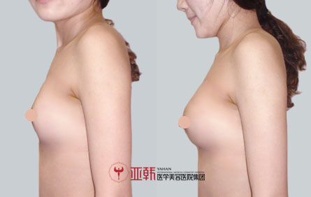 假体丰胸案例对比