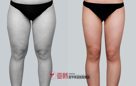 大腿吸脂